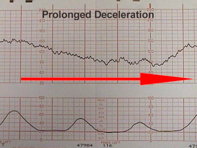 electronic-fetal-heart-monitoring